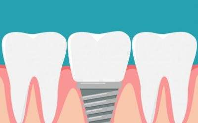 What You Should Know About Dental Implants