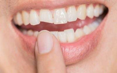 Chew on This: Why You Shouldn’t Ignore a Cracked or Chipped Tooth