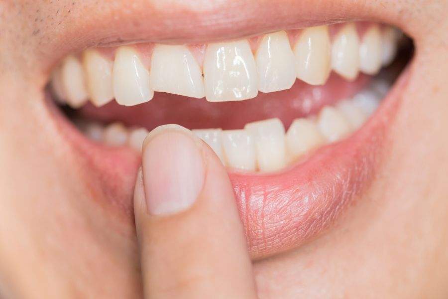 Chew on This: Why You Shouldn’t Ignore a Cracked or Chipped Tooth