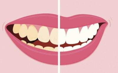 Understanding Tannins and Teeth Discolouration