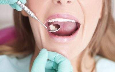 How Often Should You Go to the Dentist?