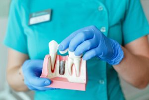 Dental Implant cost explanation