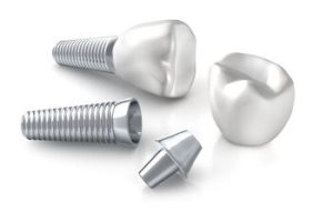 Dental Implant cost parts