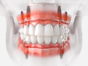 
complete dental implants costs townsville