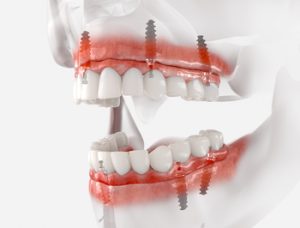 
full mouth dental implants value townsville