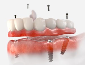 
price of entire mouth implants townsville