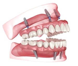 Cost-For-Full-Mouth-Dental-Implants-image