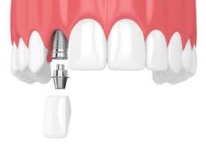 bali dental implant procedure townsville