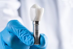 bali dental implant types townsville