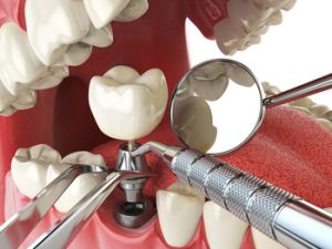 cost of dental implants thailand procedure