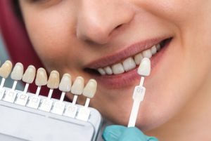 Veneers For Overlapping Teeth colour