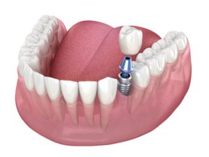 Dental Implants Turkey procedure