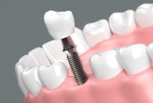 Dental Insurance That Covers Implants materials