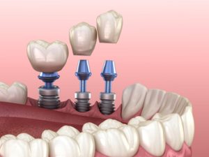 3,Tooth,Crowns,Placement,Over,3,Implants,-,Concept.,3d