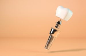 dental implant cost Bali single