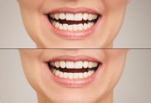 Bad Veneers Vs Good Veneers results