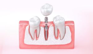 Dental Implant Kuala Lumpur placement