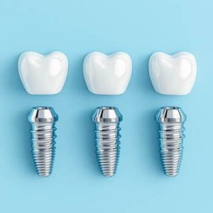 Dental Implant Kuala Lumpur quality