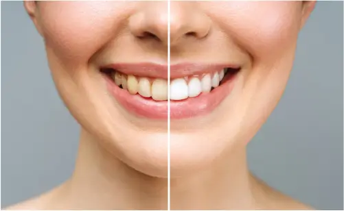 In-Chair Teeth Whitening Offer Casey Dentist